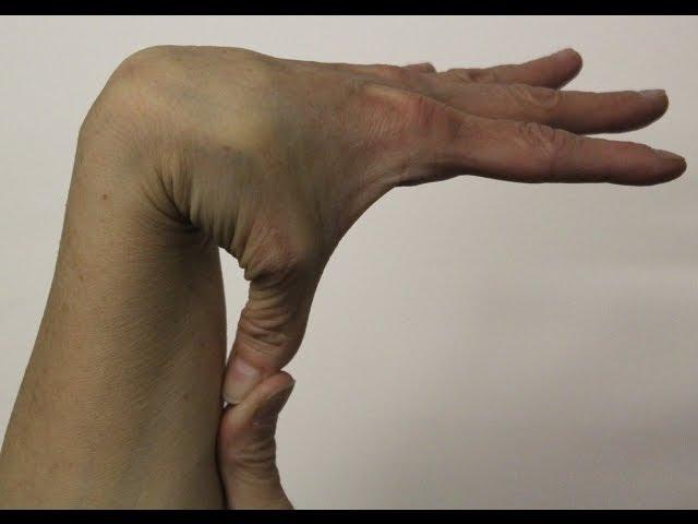 Дисплазия соединительной ткани в практике врача-педиатра&nbsp;